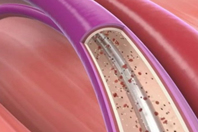 Prevention Of Thrombus Accumulation On Vascular Access Products Can Have Positive Impact Evonik