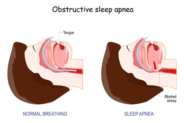 Obstructive Sleep Apnea GettyImages-1292002349 Obstructive Sleep Apnea GettyImages-1292002349