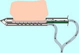 Breast Biopsy Device