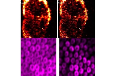 photoacoustic-lihong-wang-melanoma-cells