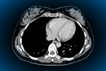 CT scan heart