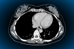 CT scan heart