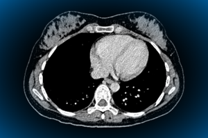 CT scan heart