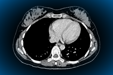 CT scan heart CT scan heart