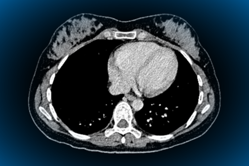 CT scan heart