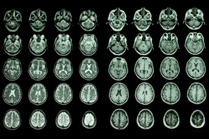 Brain in MRI-GettyImages-157180156
