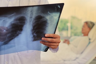 CL_Critical Milestones-Lung Cancer Case Study